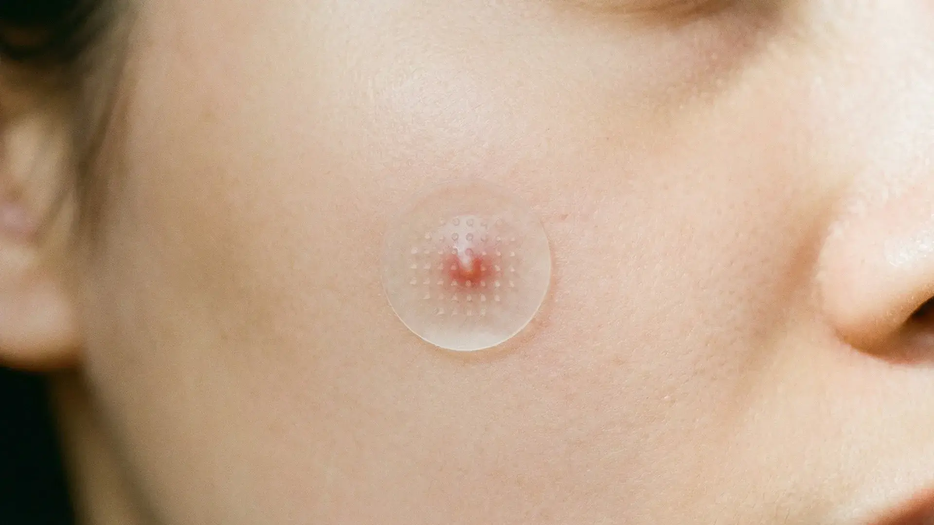 Microneedle acne patch