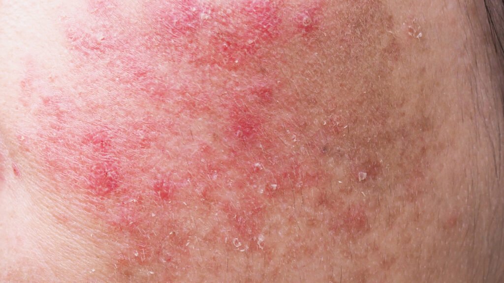 Hindari over eksfoliasi dari produk kimia aktif