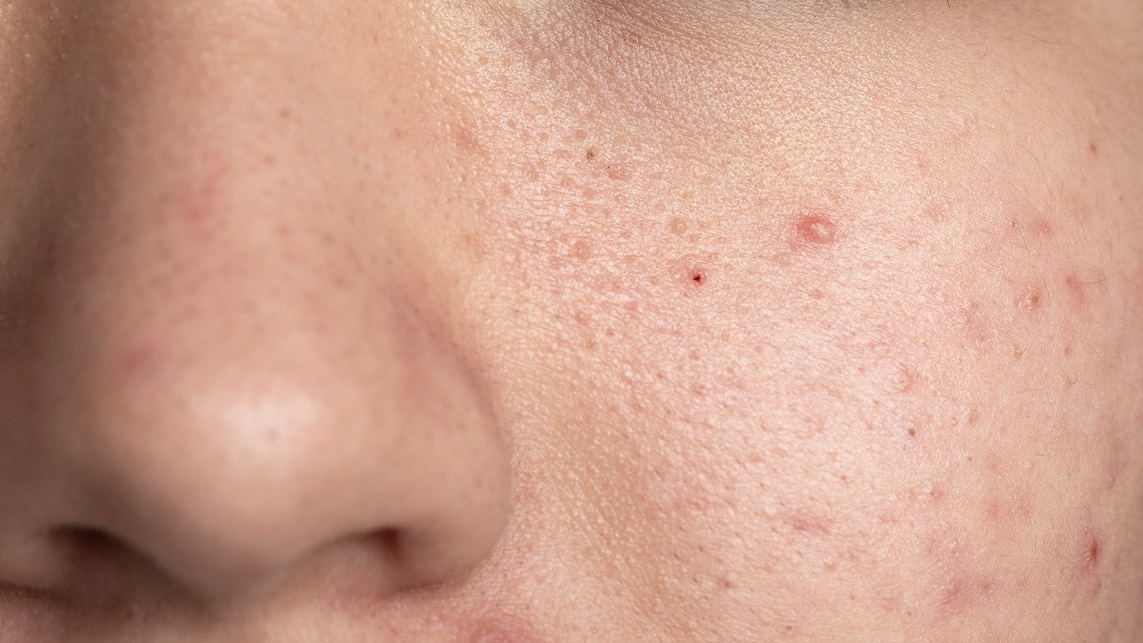 Skin Barrier Rusak, Night Care Jadi Kunci Bukan Tambahan