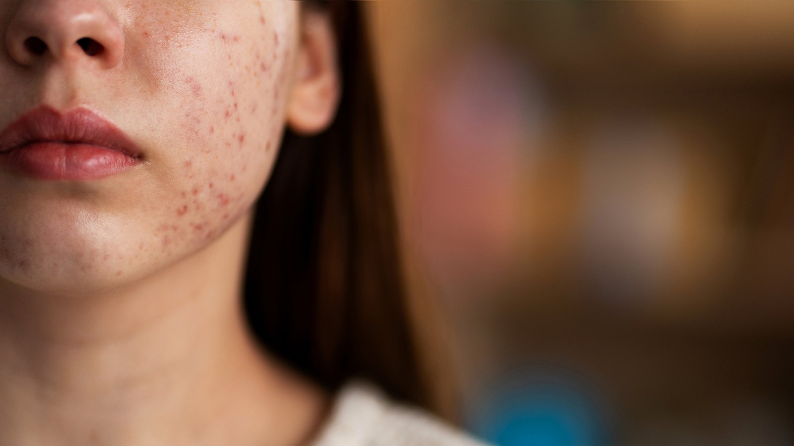 Analisa kondisi kulitmu, bisa jadi jerawat yang dialami merupakan hormonal acne