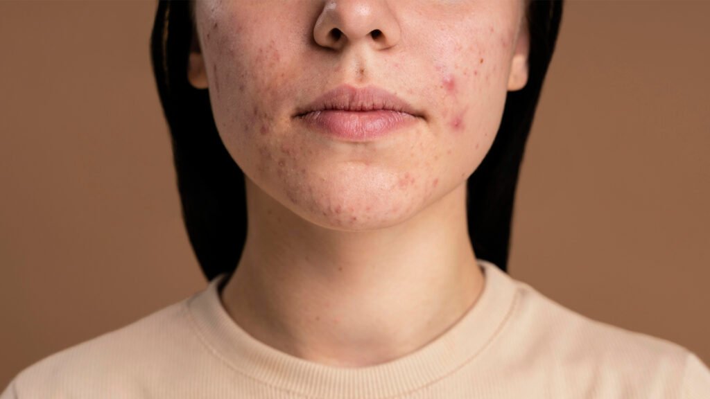 Jerawat yang berada di lokasi berulang bisa disebabkan karena hormon atau stress